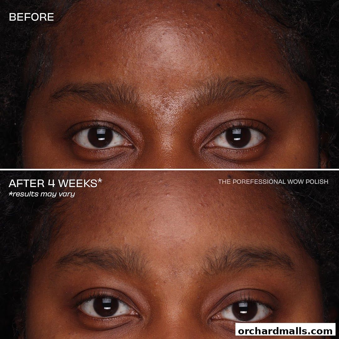 Before and after comparison of skin treatment results after 4 weeks.