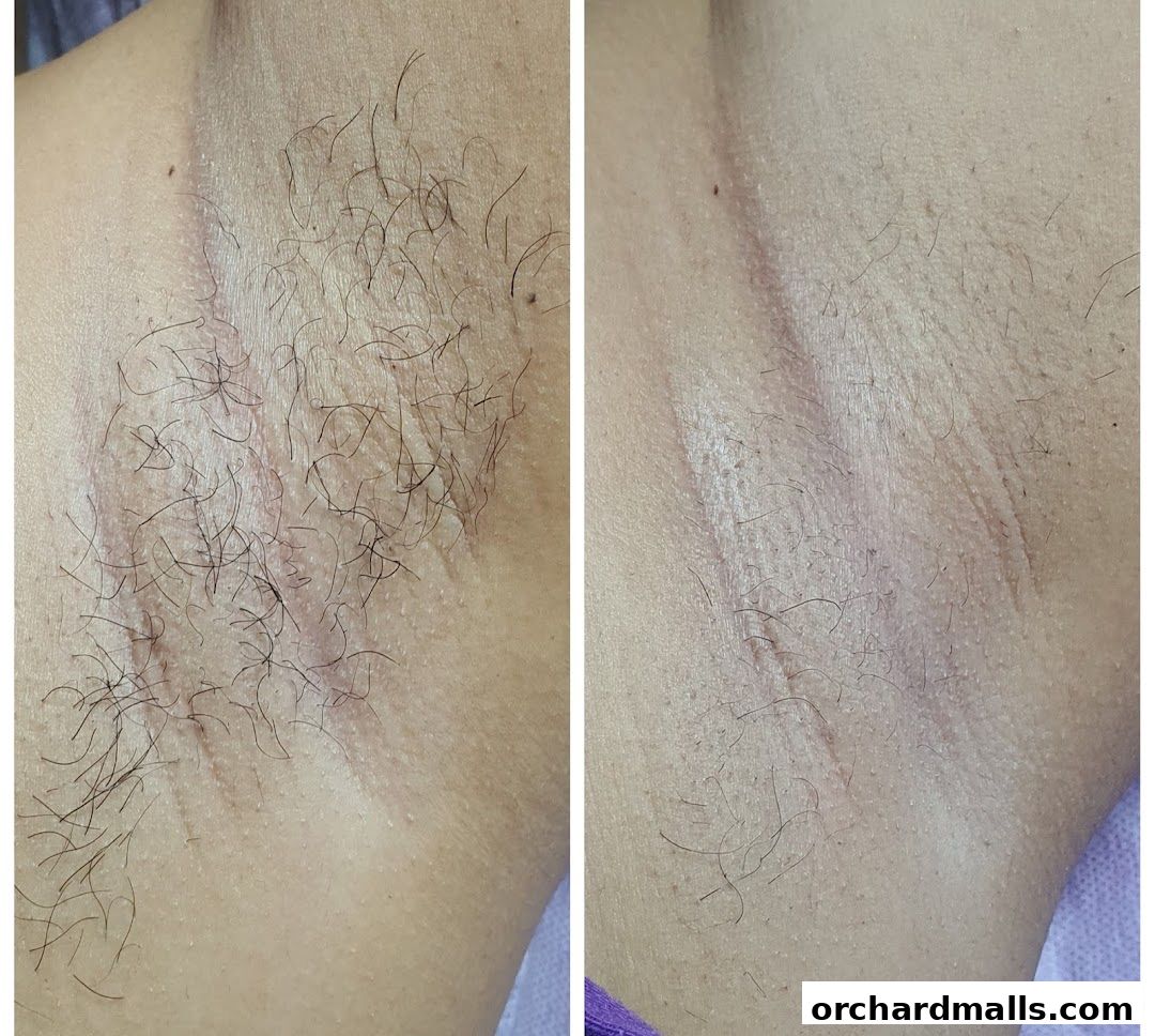 Blush  Orchard, The Hair Removal Specialist  Laser  Waxing
