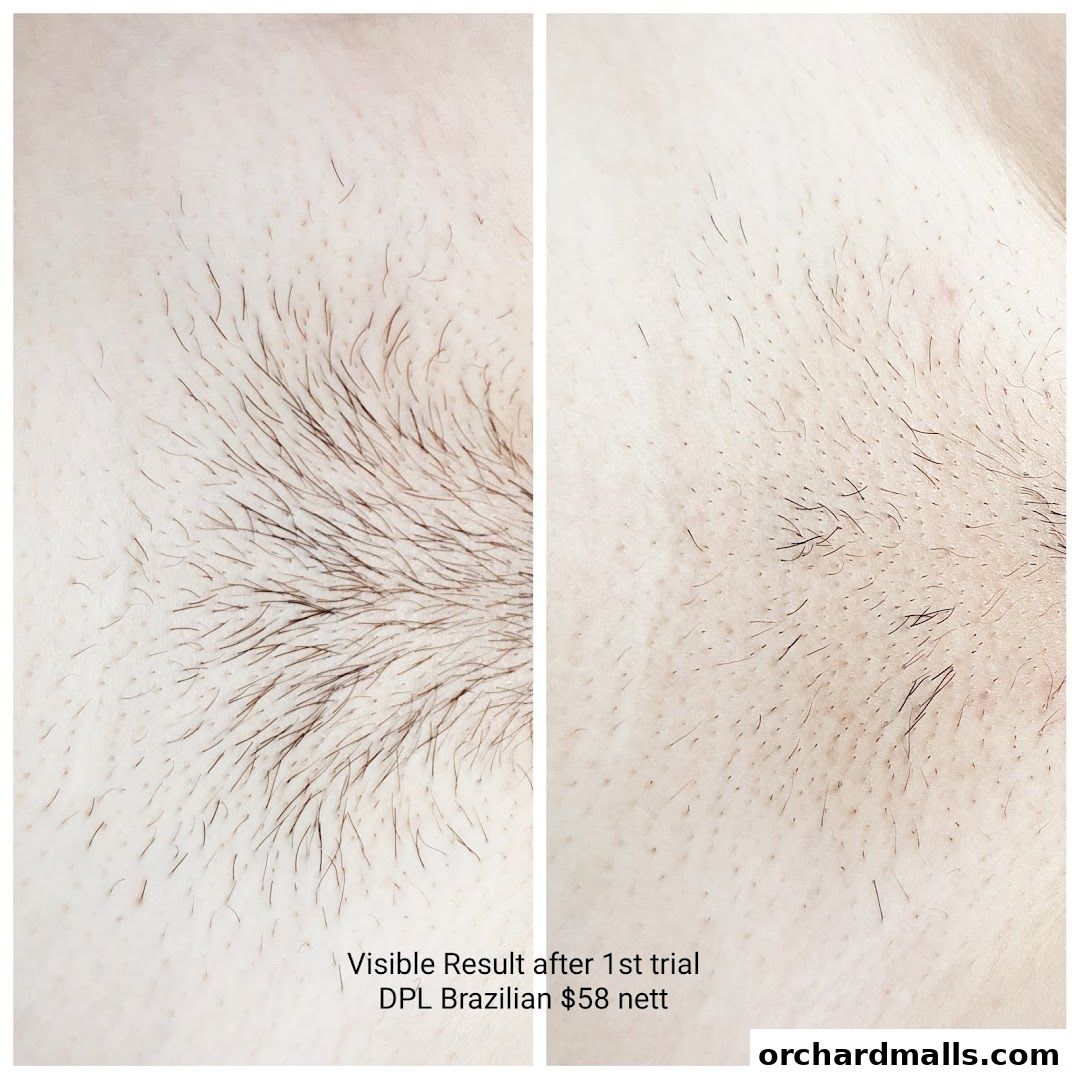 Blush  Orchard, The Hair Removal Specialist  Laser  Waxing