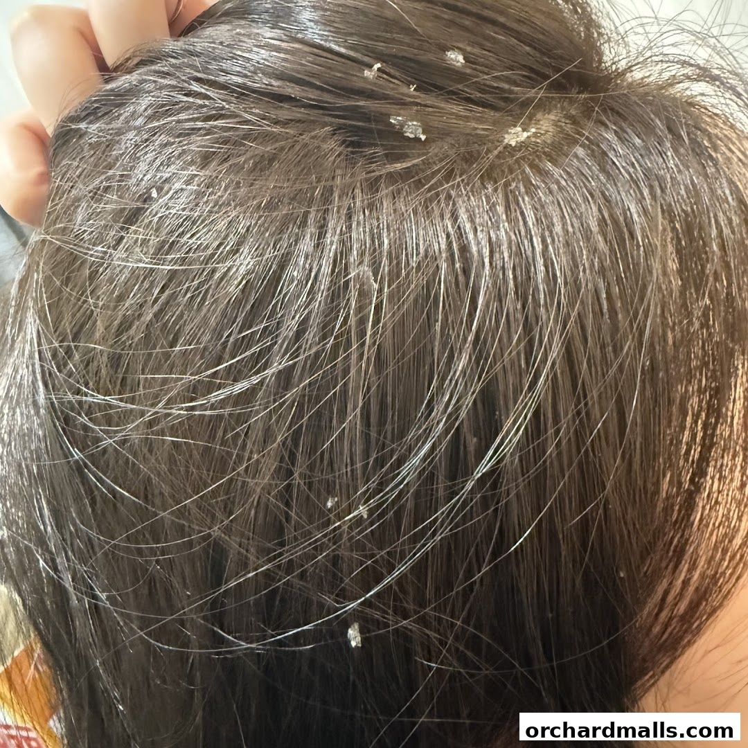 Close-up of dark hair with visible flakes, possibly dandruff.