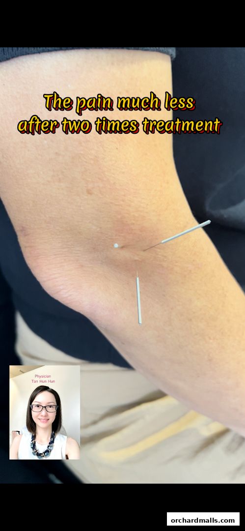Acupuncture needles inserted into an arm, with text about pain relief.