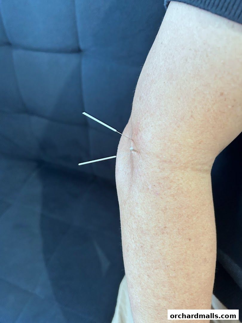 Close-up of acupuncture needles inserted into an arm for treatment.