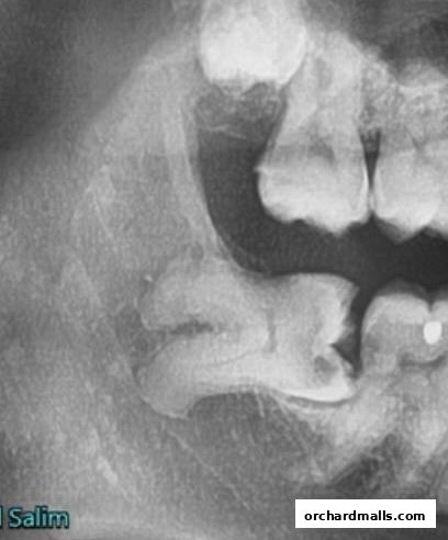 A dental X-ray showing teeth and jawbone structure.