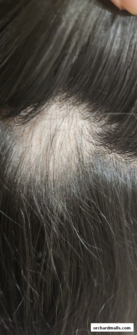 Close-up of thinning hair on a scalp, showing areas of hair loss.