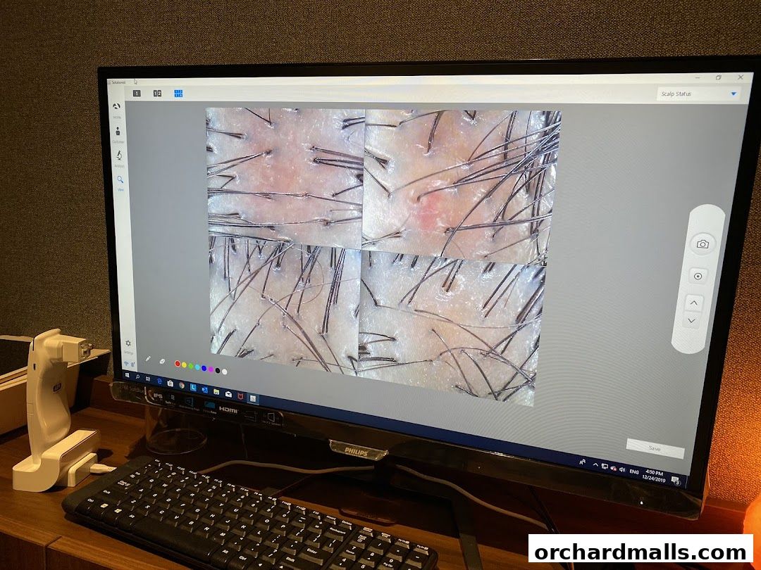 Computer screen displaying a magnified view of scalp conditions with hair follicles.