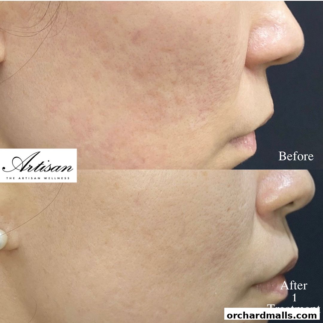 The Artisan Wellness - Body Contouring  Fat Loss  HIFU  Diastasis Recti Singapore