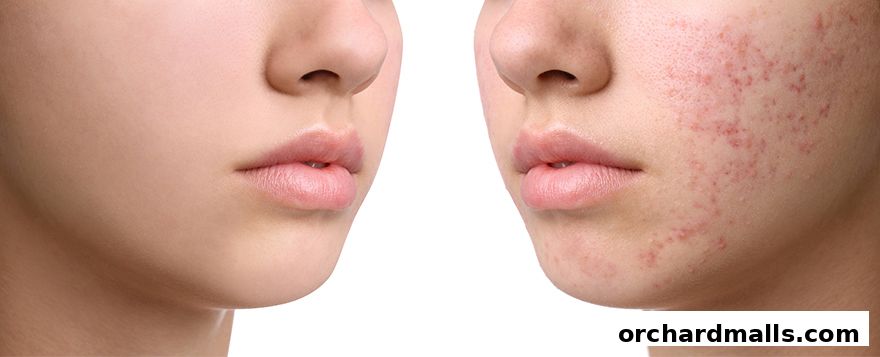 Split image showing a comparison of clear skin versus skin with acne.