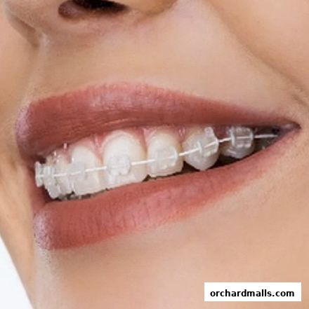 Close-up of a person's mouth with clear braces on their teeth.