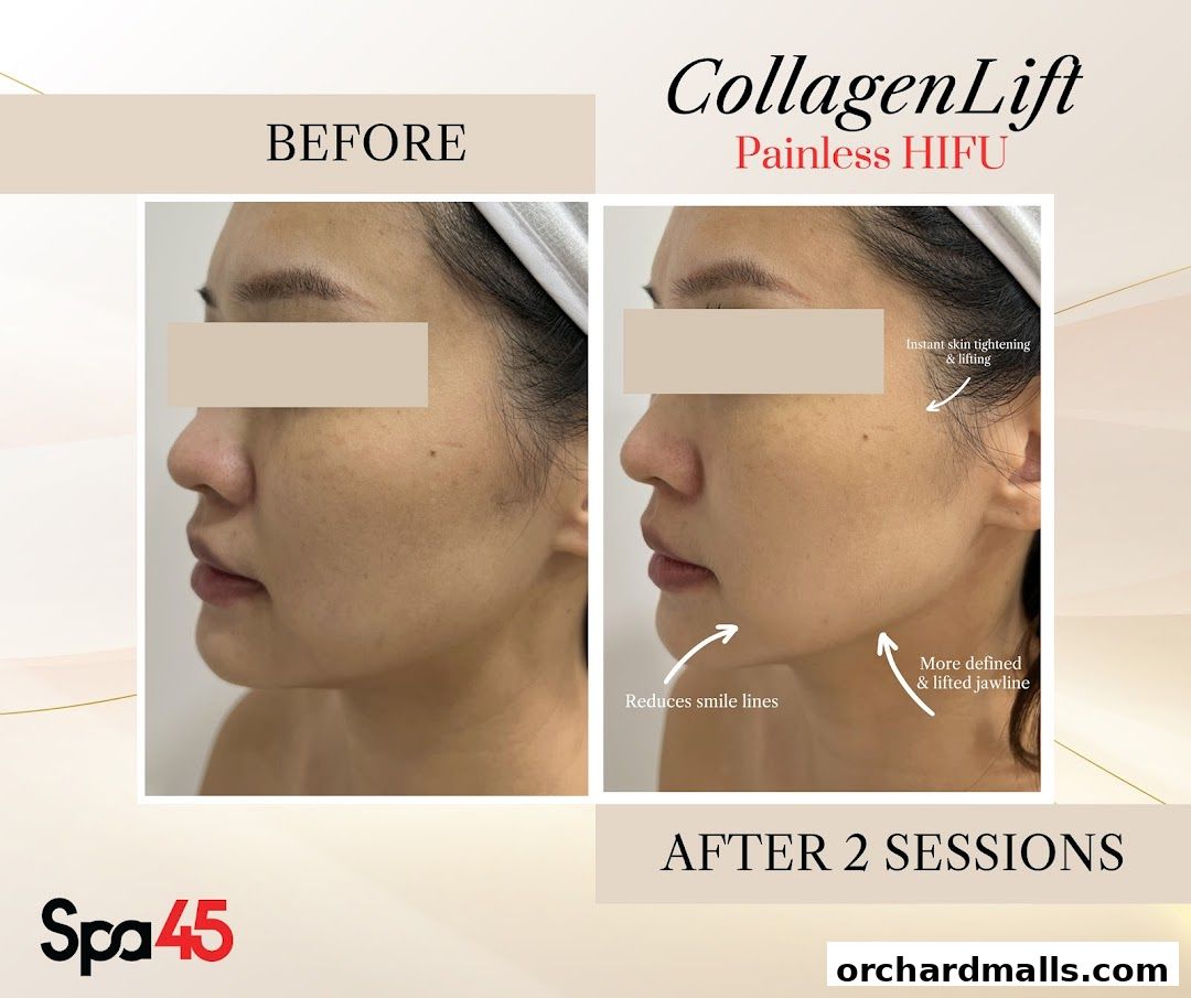 Vim Beauty - Facials  HIFU  Exosomes  Bojin  Guasha